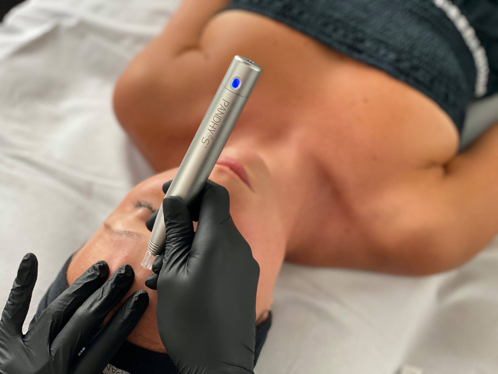 microneedling, derma pen